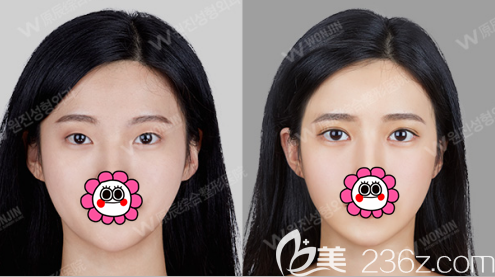 Examples of double eyelid surgery at Wonjin Plastic Surgery