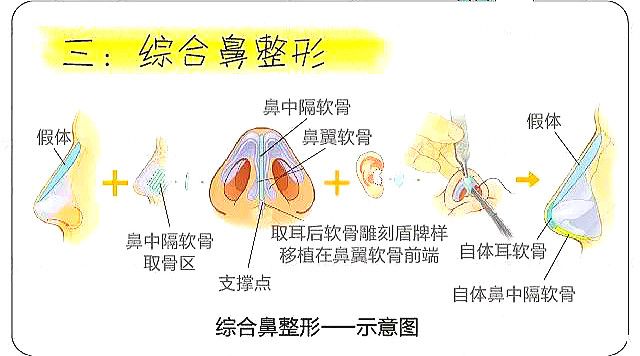 Comprehensive nose reshaping