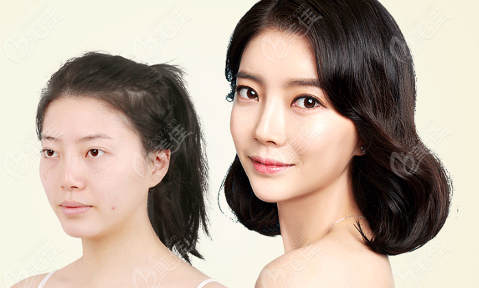 nose surgery nose surgery