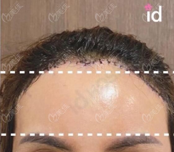 forehead reduction surgery