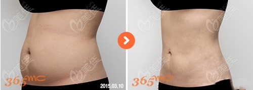 one-day liposuction
