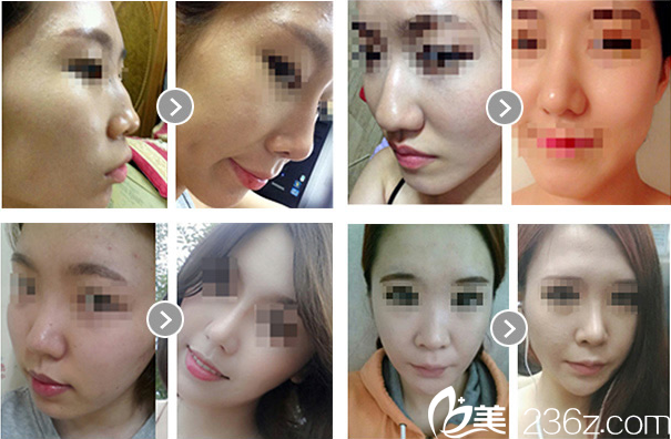 nose augmentation