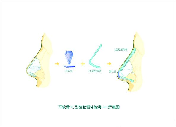 L-shaped implant with ear cartilage nose augmentation