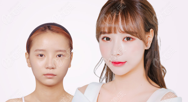 Good reputation for double eyelid surgery Good reputation for double eyelid surgery