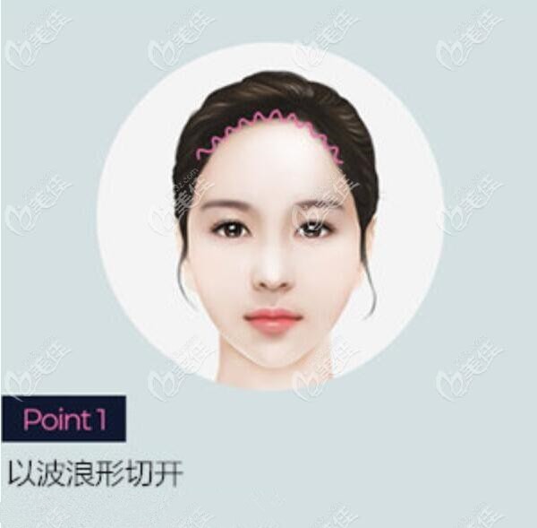 Which Hospital in Korea is Good for Forehead Reduction Surgery?