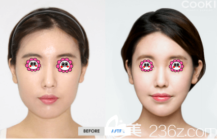 How is Cooki Plastic Surgery for facial contouring?
