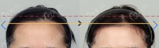 forehead reduction