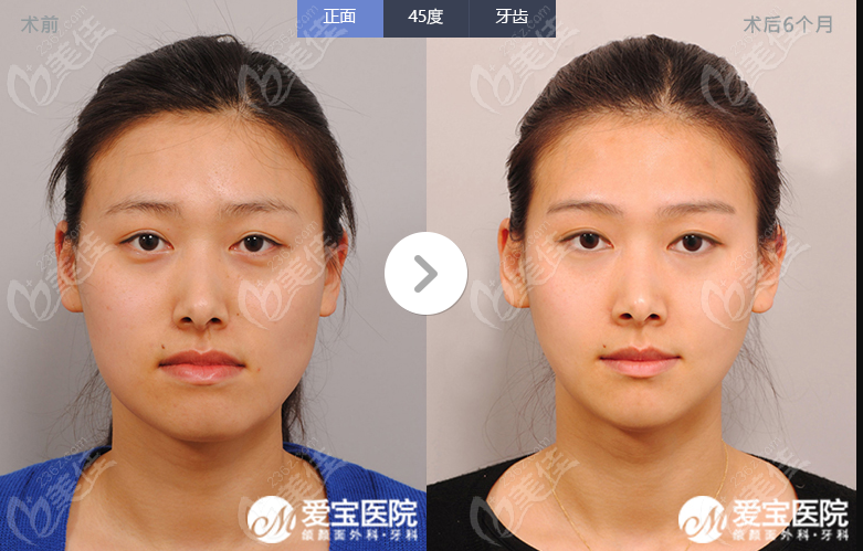  before and after comparison of double eyelid surgery