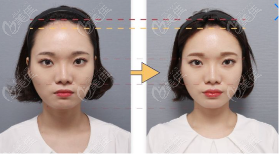  forehead reduction