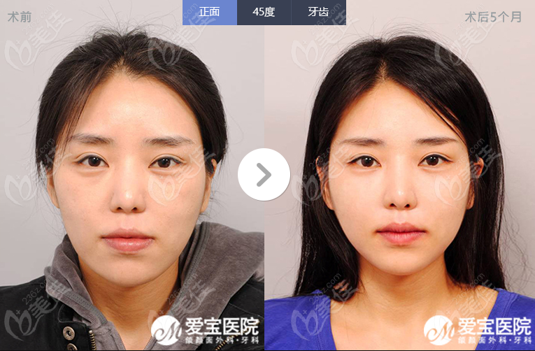 double eyelid surgery