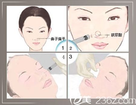 Hyaluronic Acid Injections