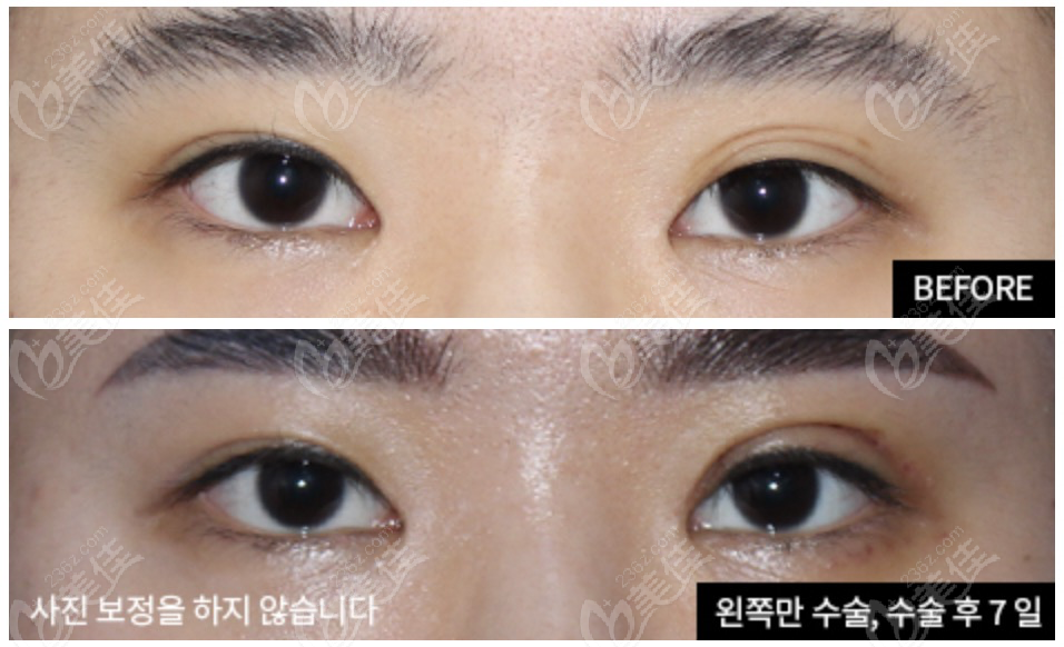 multiple eyelid repairs