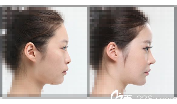 rhinoplasty