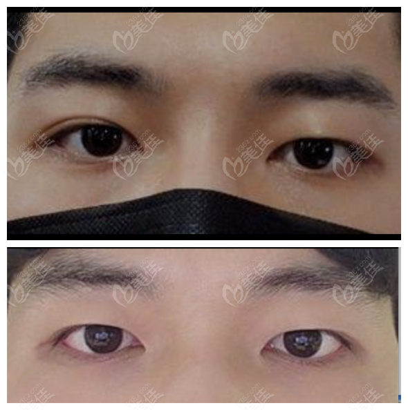 transformation from shallow double eyelids to deeper ones