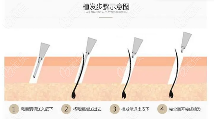 How is the Hair Transplantation Technology in Thailand?