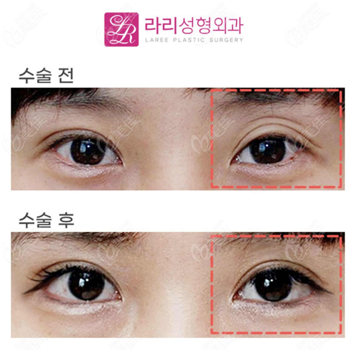 triple eyelid repair