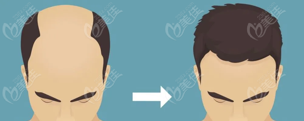 hair transplantation