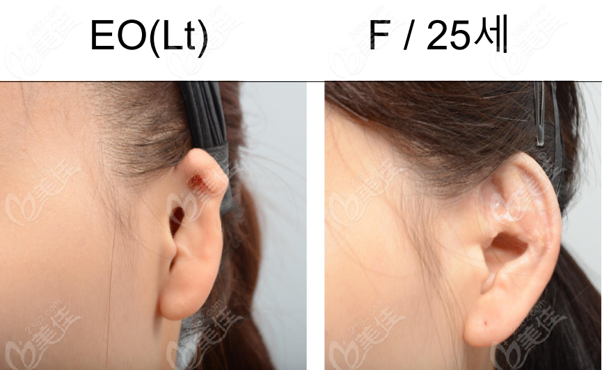 What about Dr. Zheng Zaihao's Ear Reshaping Procedures?