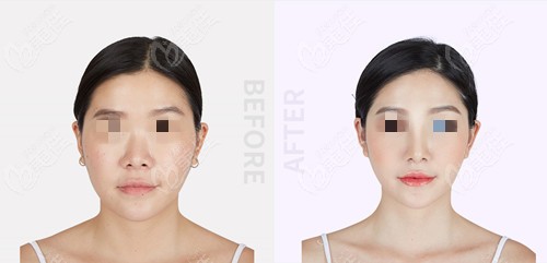 nose augmentation surgery