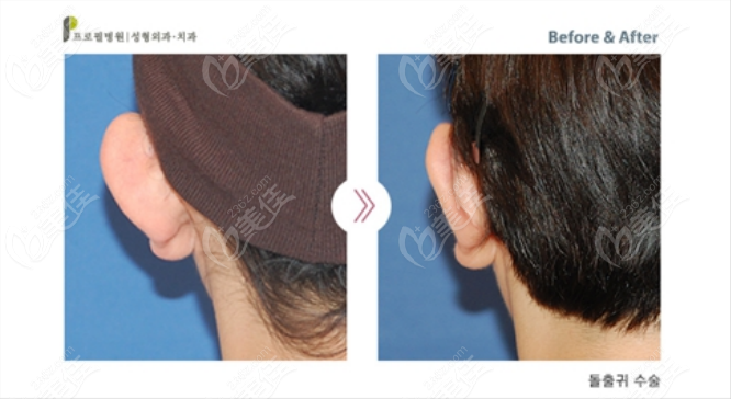 Ear Reshaping Procedures