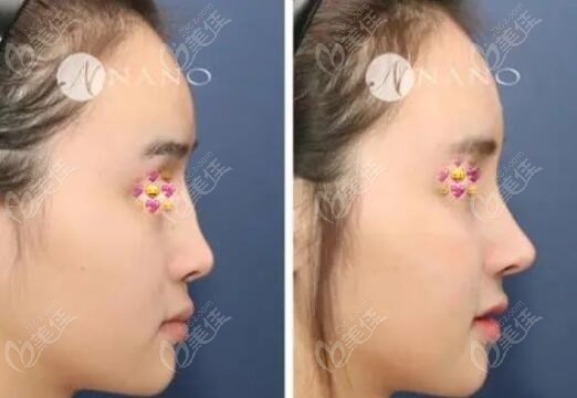 extensive experience in nose surgery