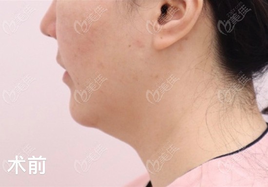 Face Liposuction Example at LIBAN Clinic: Fast Recovery, No Sagging