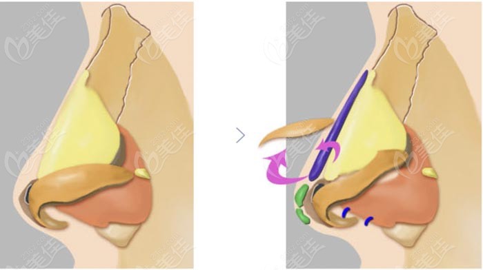 nasal repair surgeries