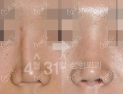 nose augmentation