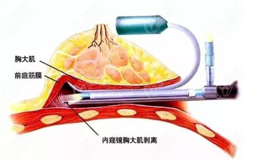 How is the breast augmentation technique of Cui Wenxie?