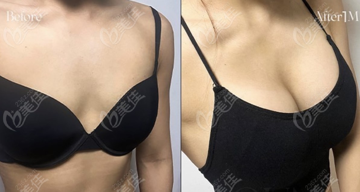 breast augmentation