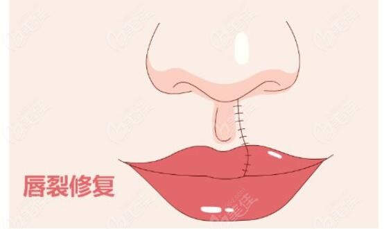 Cost of Cleft Lip Repair Surgery in Korea