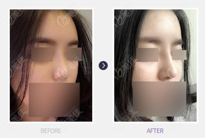 contracted nose repair surgery