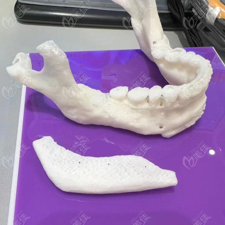 3D customized bone augmentation