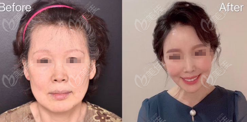 Examples of facelift surgery