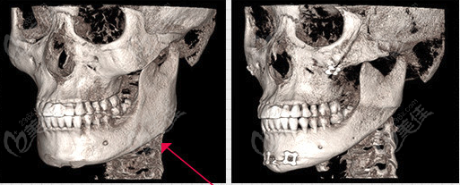 contouring surgery