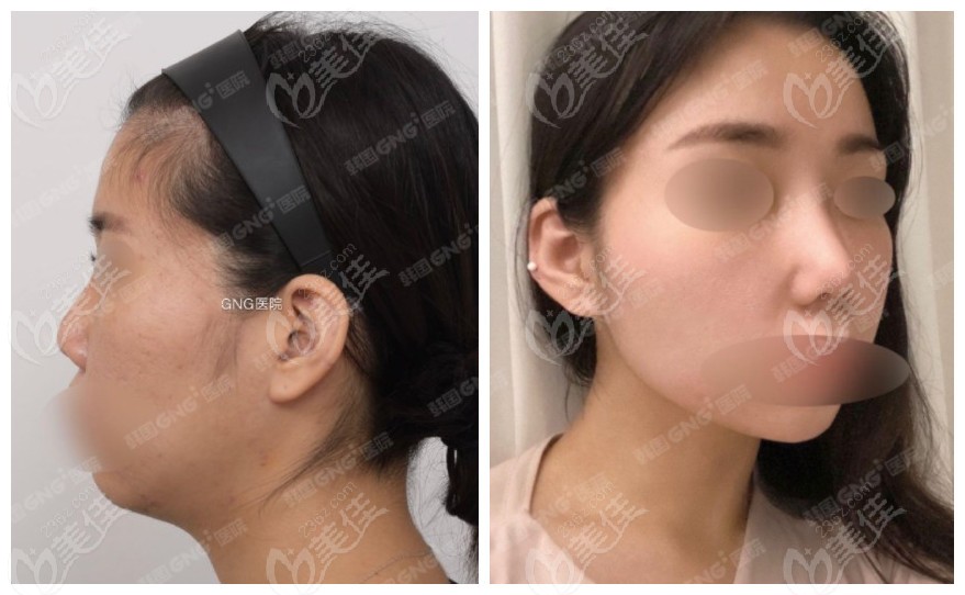 nose repair surgery