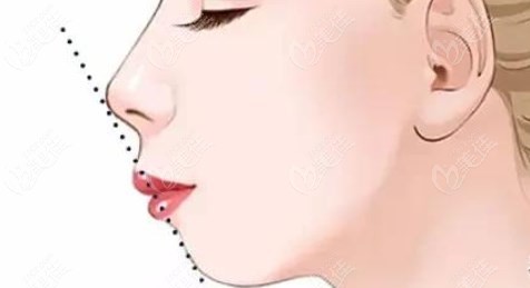 protruding lips surgery