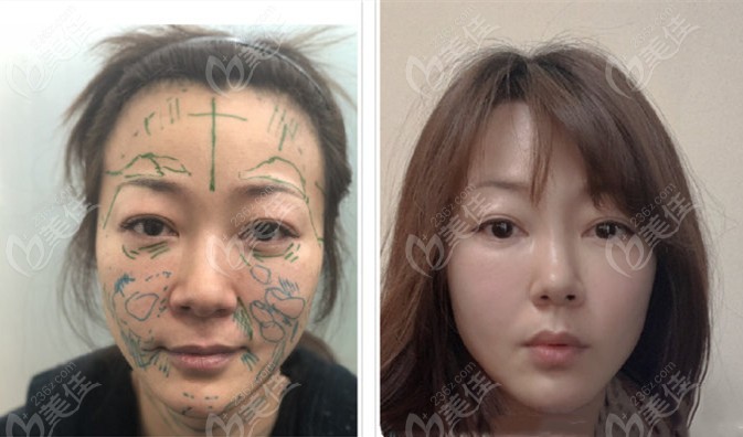Facial Fat Restoration