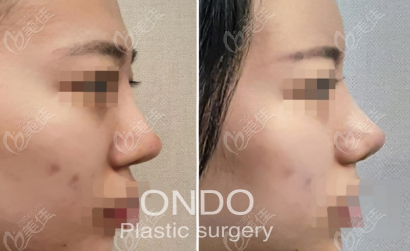 Is ONDO Plastic Surgery Good for Nose Job?