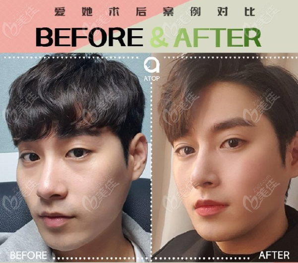 How Is Atop Plastic Surgery It Is Famous For Its Facial Lifting And