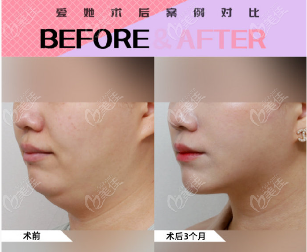 facial liposuction