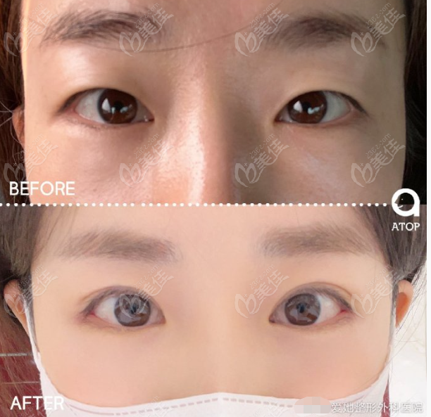 double eyelid surgery