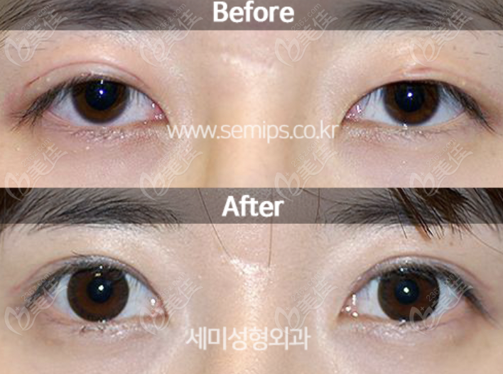Eyelid Scars repair