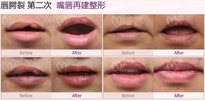 cleft lip repair