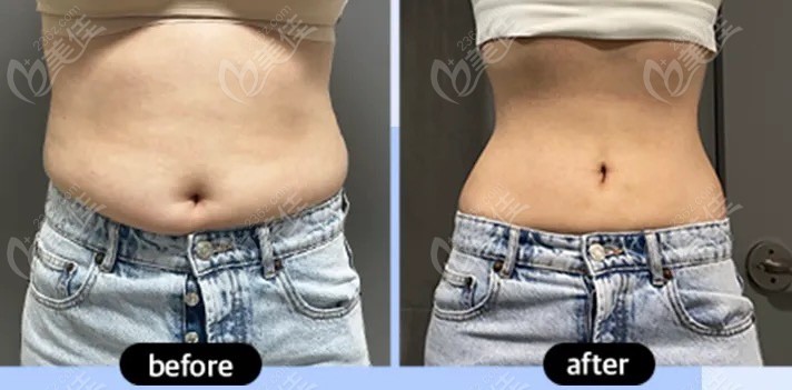 lams liposuction