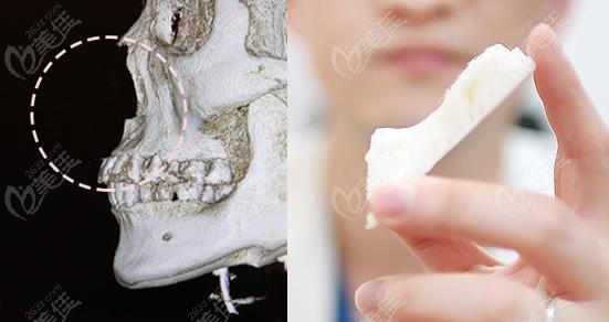 3D-printed nasal surgery