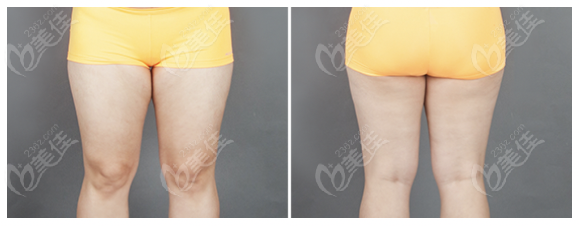 Thigh liposuction