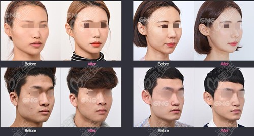 GNG's contouring