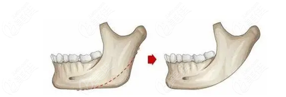 V-line jaw contouring