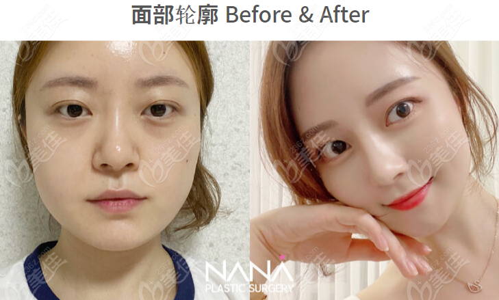 How is NANA Plastic Surgery's facial contouring?